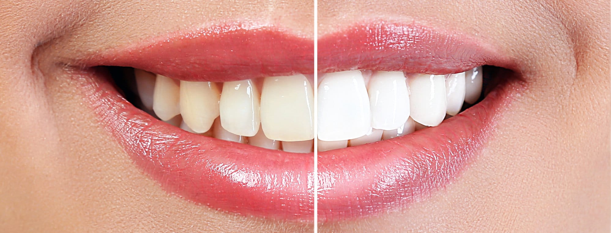 Izbjeljivanje zuba prije - poslije