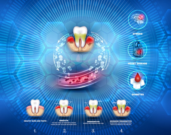 Zubni kamenac uzrokuje organska oštećenja sustava
