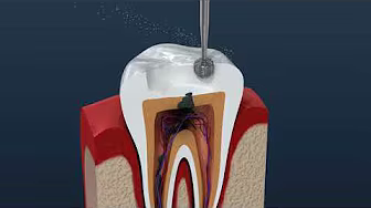 Endodoncija
