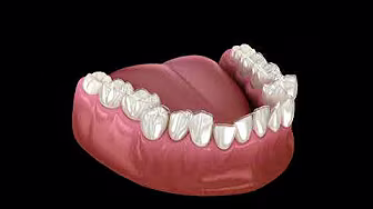 Aligner treament