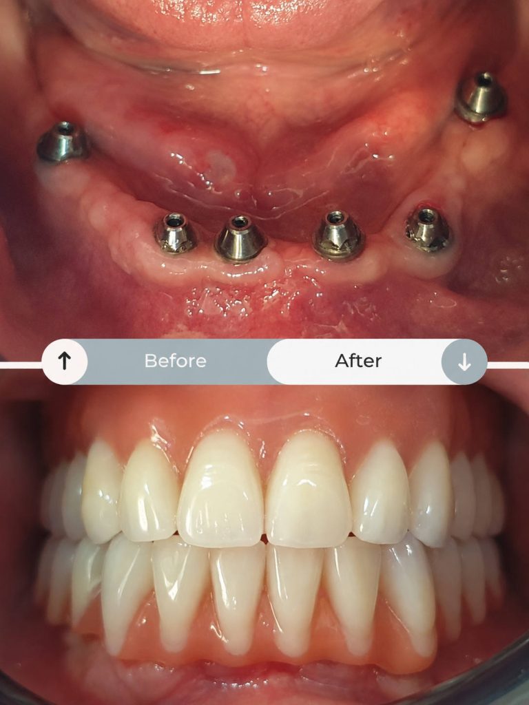 Show the before and after situation in implantology