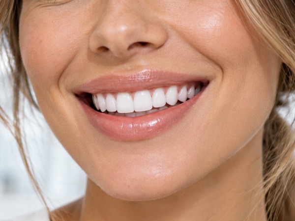 Veneers